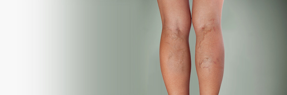 Arm with subcutaneous hematoma